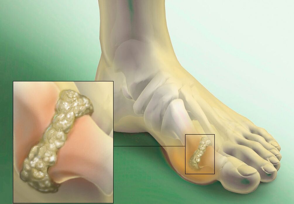 salt deposition in gout